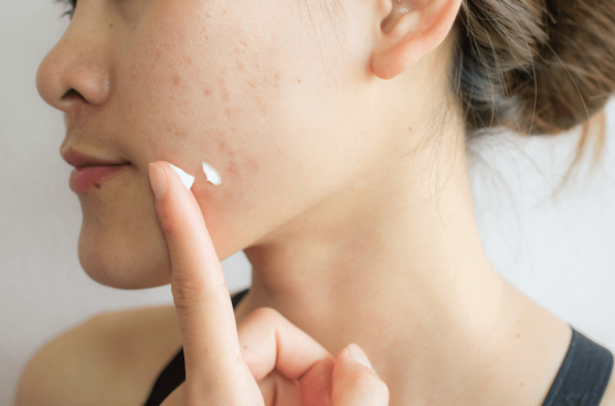 What Causes Acne Scars