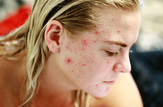 What Causes Adult Acne