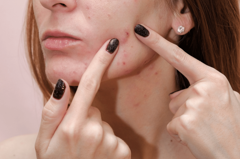 What is Sebum and What Role Does It Play in Acne